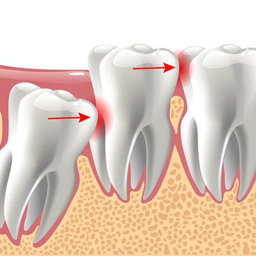 impacted tooth illustration for tooth extractions in Indian Land