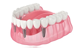 a digital illustration of fixed/permanent implant dentures