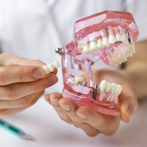 a dentist holding a model of dental implants