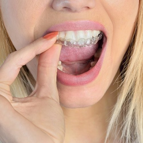 close up woman removing Clear Correct clear aligner