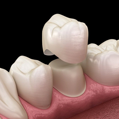 diagram of dental crown being placed on tooth 