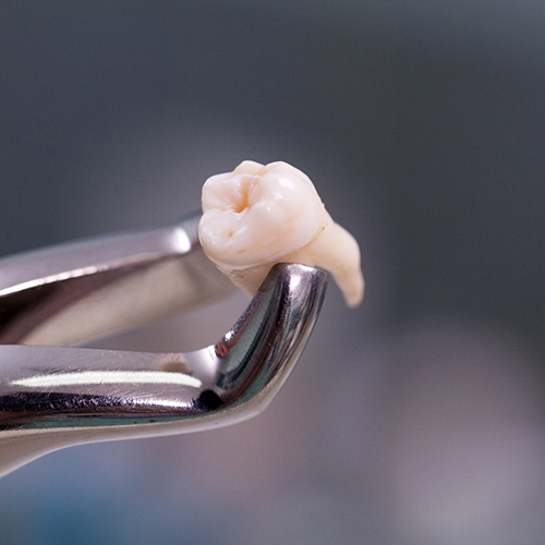 Extracted tooth in Indian Land