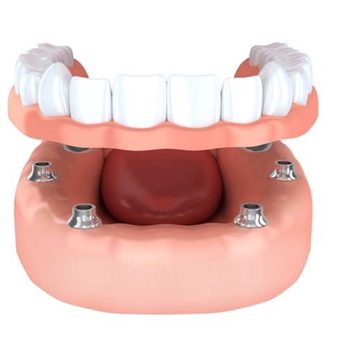 Animation of implant-retained dentures 