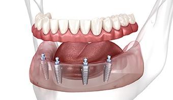 a digital illustration of removable implant dentures