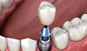 Diagram of single tooth dental implant in Indian Land