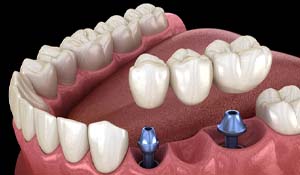 Diagram of an implant bridge replacing multiple missing teeth in Indian Land