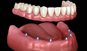 Diagram showing an implant denture in Indian Land