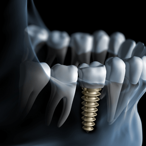 Animation of implant supported replacement tooth