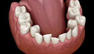 Illustration of crooked teeth