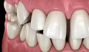 Illustration of gapped teeth