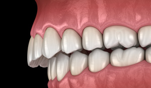 Illustration of an overbite
