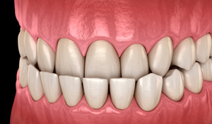 Illustration of an underbite