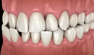 Illustration of a crossbite