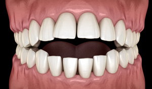 Illustration of an open bite