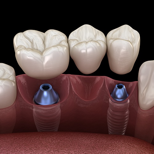 Animation of implant supported dental bridge placement