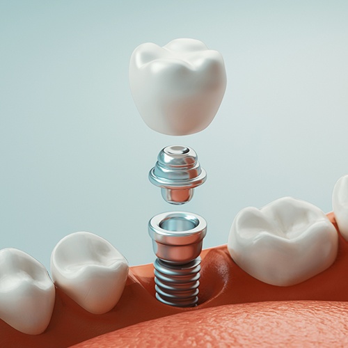 Animation of dental implant placement