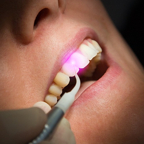 Woman receiving laser dentistry treatment