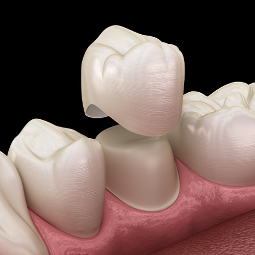 Animation of dental crown placement