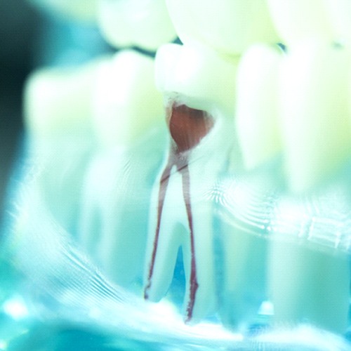 dental X-ray showing an infected tooth