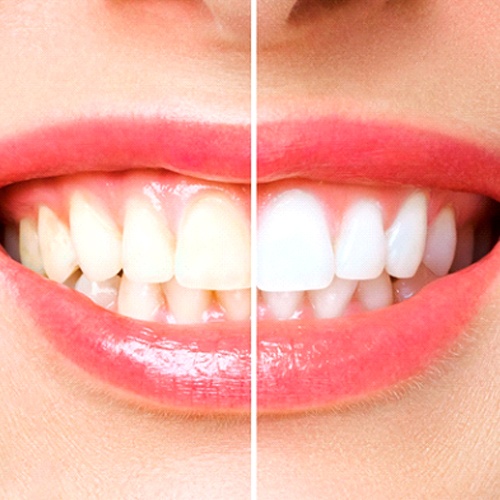 Before and after of patient's smile after teeth whitening in Indian Land