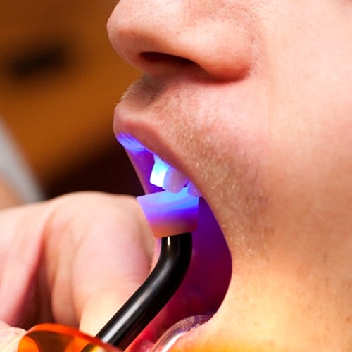 man getting tooth-colored fillings