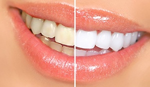 Before and after teeth whitening