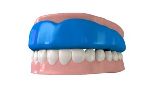 Dental model of an athletic mouthguard