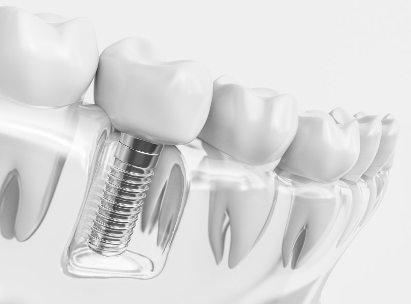 3D render of a dental implant
