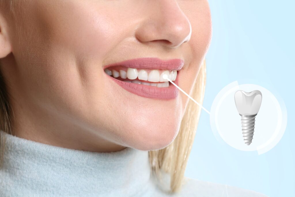 Nose-to-neck view of woman smiling with one tooth indicated as implant