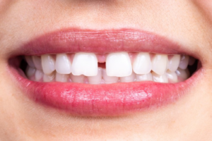 Close up of a gap between two front teeth